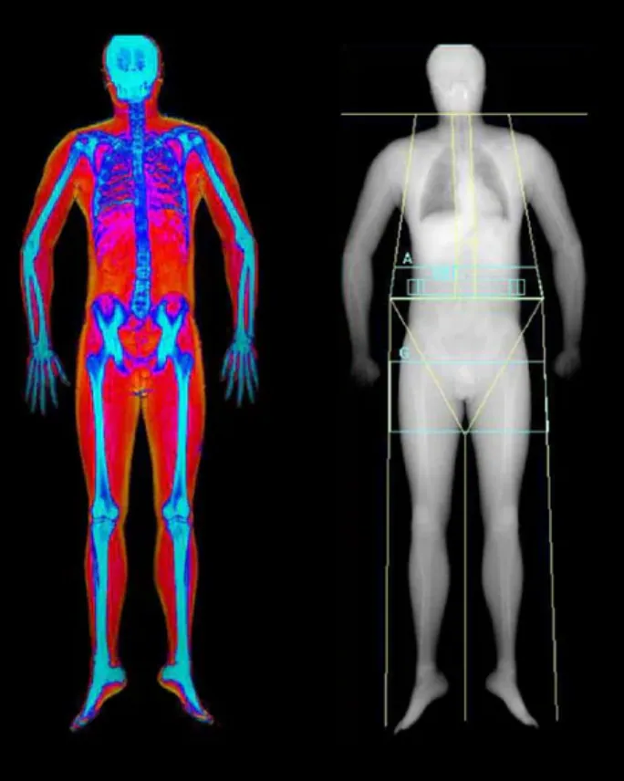 An example of a DEXA body composition scan